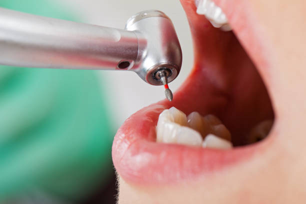 Best Emergency Wisdom Tooth Extraction in Soddy Daisy, TN
